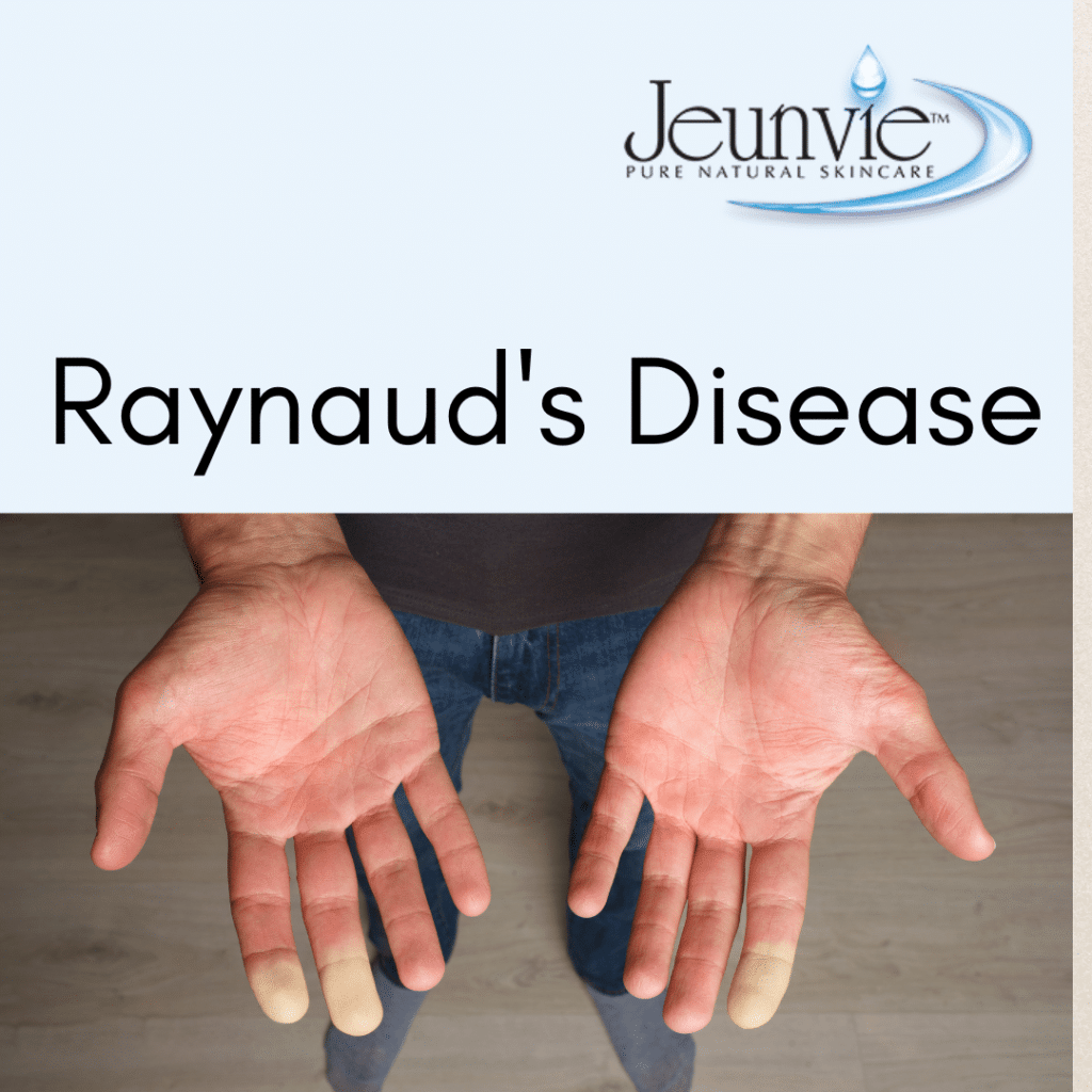 Raynaud